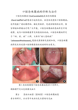 口腔念珠菌病的诊断与治疗.docx