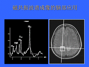 磁共振波谱成像的脑部应用.ppt