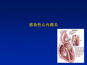 感染心内膜炎名师编辑PPT课件.ppt
