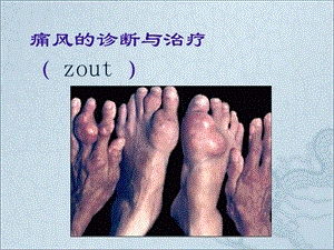 痛风的诊断与治疗讲课.ppt