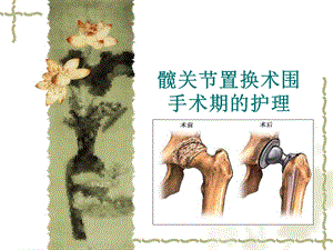 髋关节置换术围手术期的护理.ppt