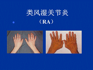 类风湿性关节炎.ppt
