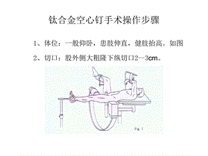 钛合金空心钉手术操作步骤.ppt