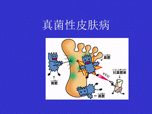 真菌性感染名师编辑PPT课件.ppt