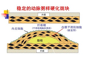 动脉硬化心脏病.ppt