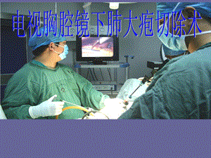 电视胸腔镜下肺大疱2.ppt