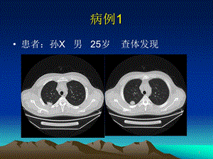 医学ppt肺错构瘤影像表现.ppt