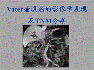 Vater壶腹癌的影像学表现及TNM分期.ppt