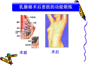 乳腺癌术后的功能锻炼.ppt.ppt