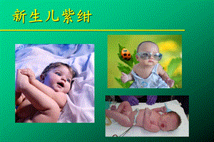 新生儿青紫.ppt.ppt