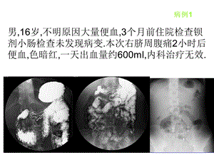 麦克尔憩室的影像学诊断1.ppt