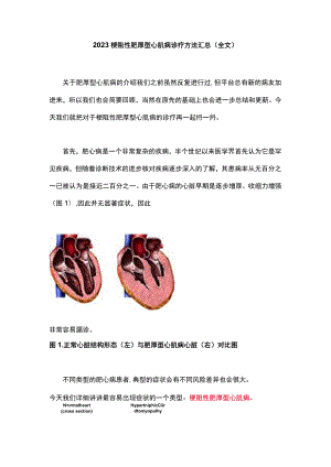 2023梗阻性肥厚型心肌病诊疗方法汇总（全文）.docx