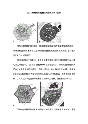 2023结缔组织病相关间质性肺病（全文）.docx