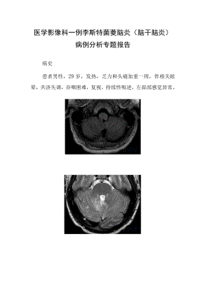 医学影像科李斯特菌菱脑炎（脑干脑炎）病例分析专题报告.docx