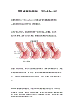 2023食管癌重要的癌前疾病——巴雷特食管（Barrett’s）.docx