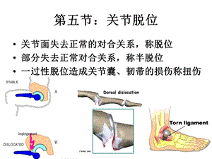 第五节关节脱位.ppt