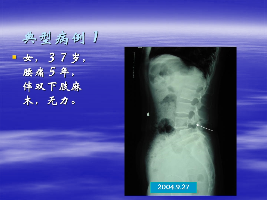 腰椎滑脱修改.ppt_第2页