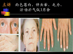 贫血anemia.ppt