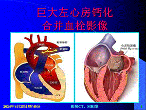 巨大左心房钙化合并血栓影像.ppt