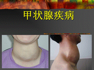 甲状腺病.ppt.ppt
