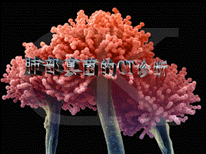 肺霉菌病影像学诊断精要.ppt
