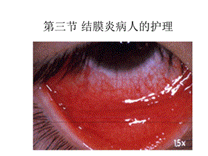 结膜炎病人的护理.ppt