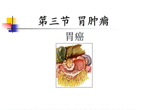 胃癌.ppt.ppt