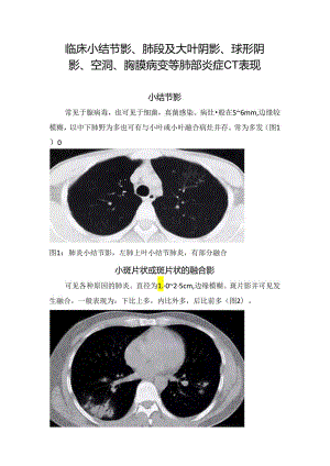 临床小结节影、 肺段及大叶阴影、球形阴影、空洞、胸膜病变等肺部炎症CT表现.docx